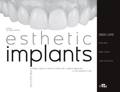 Esthetic Implants How to think about complex cases in anterior areas with a global approach to the patient smile