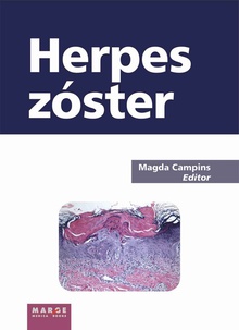 Herpes zóster