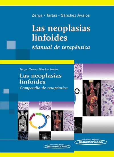 Las neoplasias linfoides